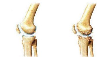 Atrocism symptoms based on knee -based