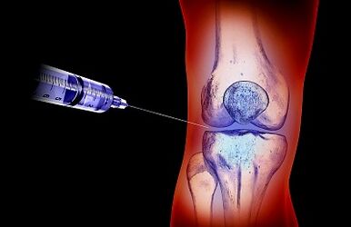 Treatment plan for knee joint arthrosis