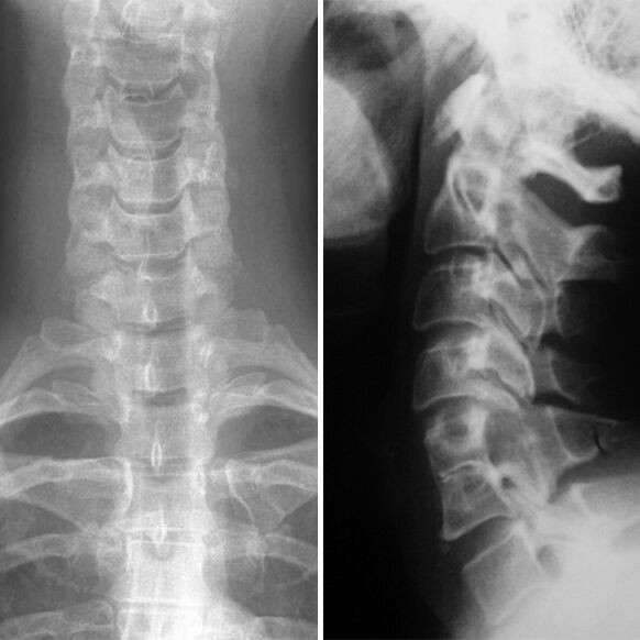 X-ray of the cervical spine